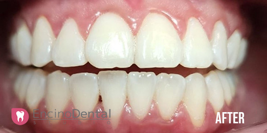 Smile result