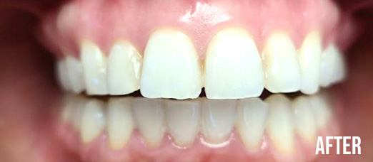 After Teeth Whitening