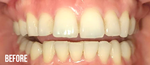 Before Teeth Whitening