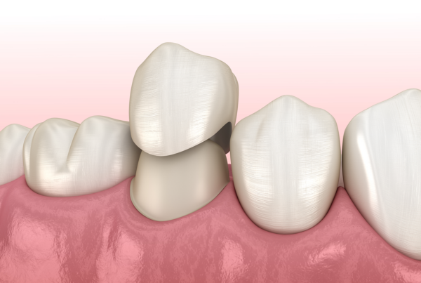 rendering of dental crown placement