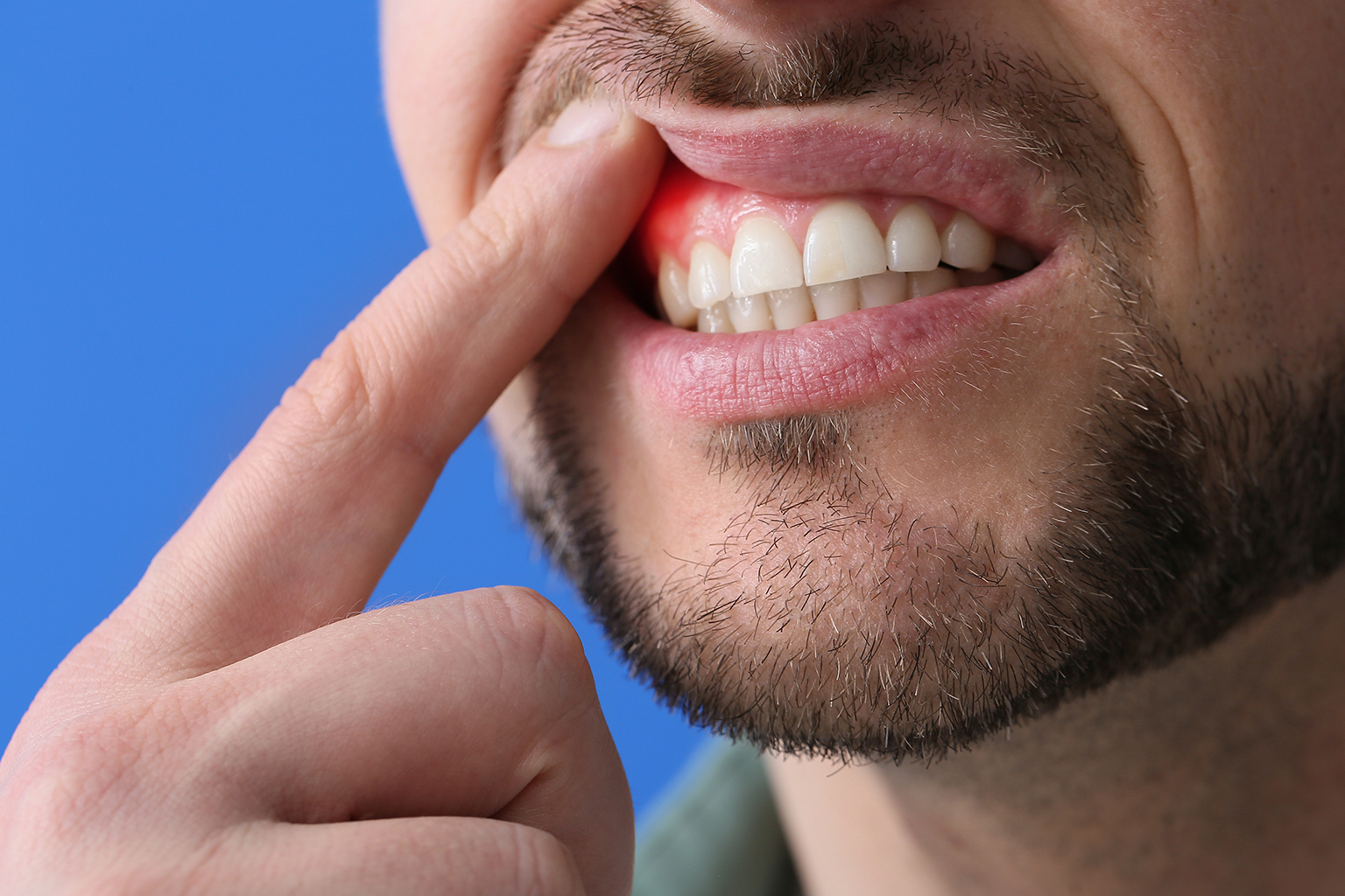 Full mouth debridement your solution for advanced periodontal disease