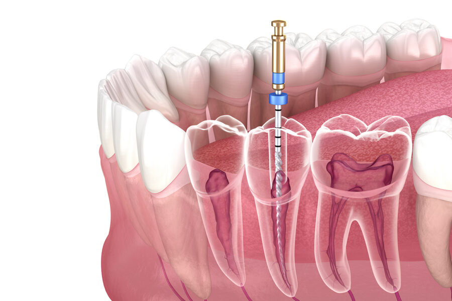 Root Canals Explained Understanding The Procedure