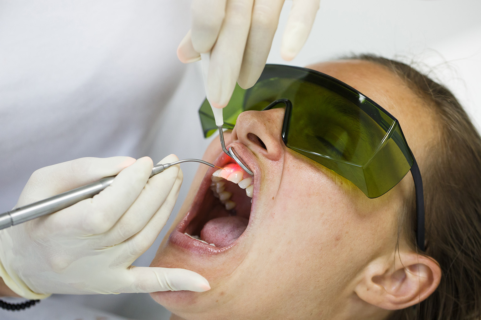 gloved hands performing  laser teeth cleaning on patient wearing eye protection