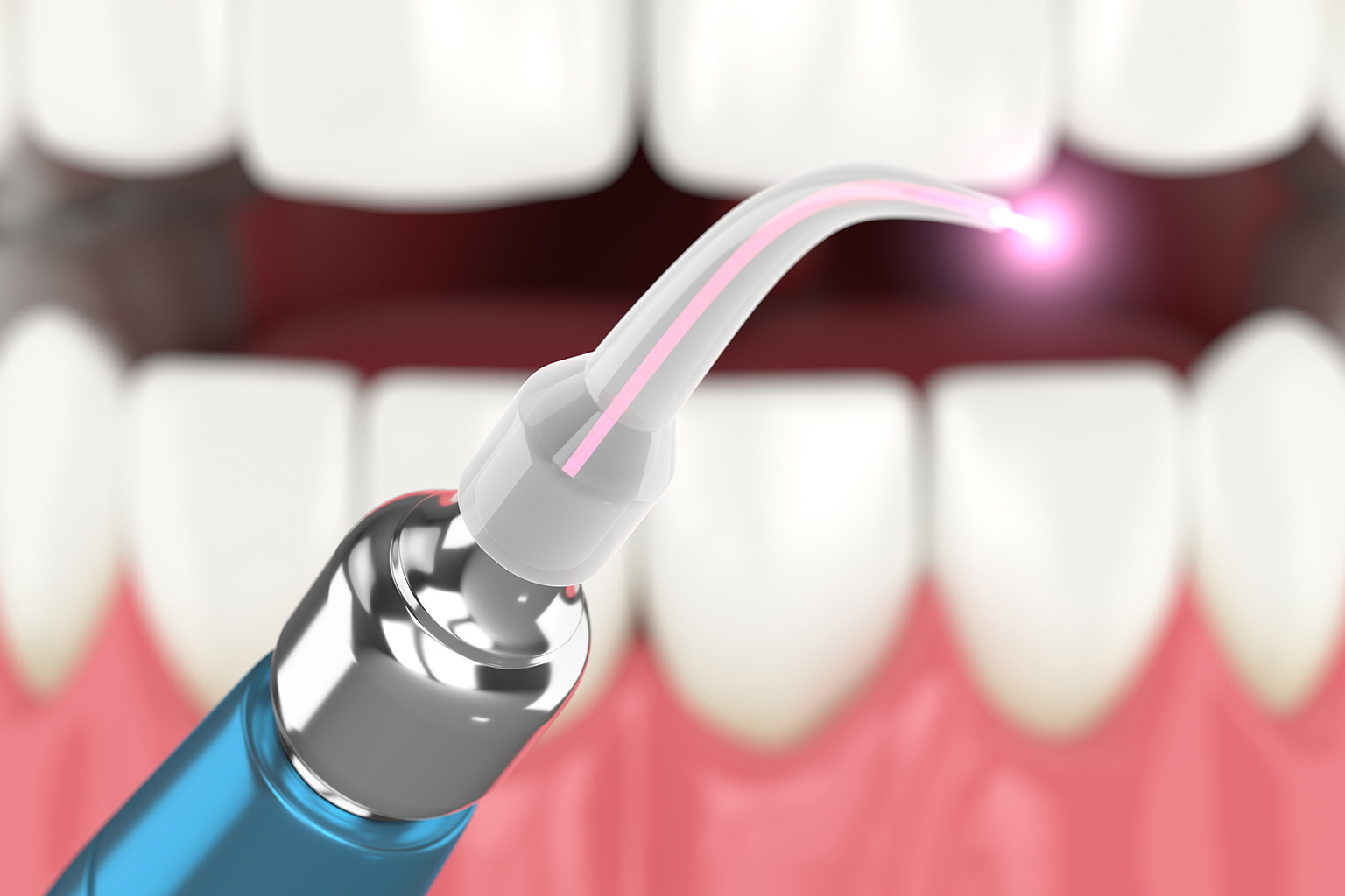 rendering of a laser teeth cleaning tool in front of teeth