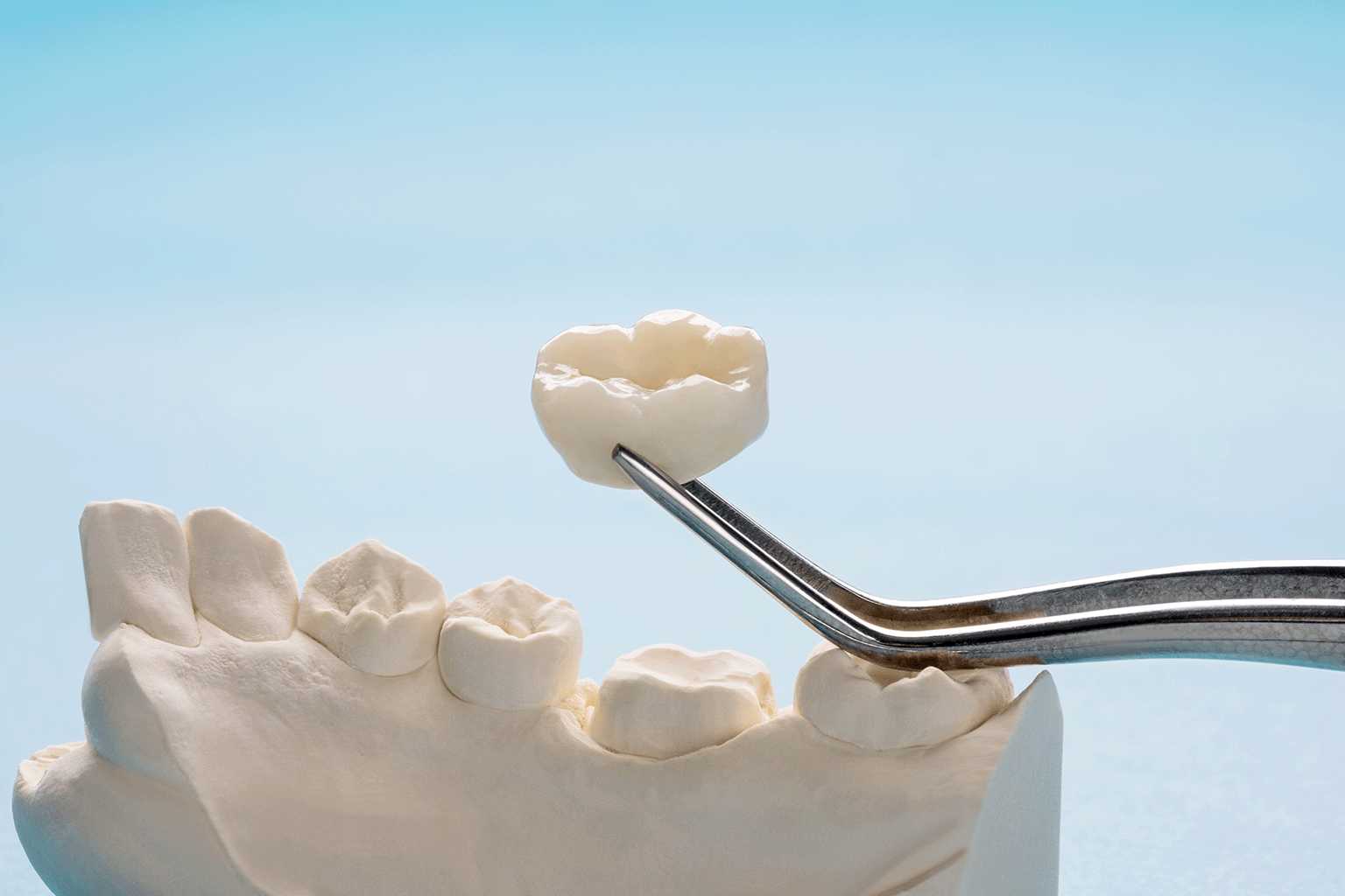 dental crown being placed on a jaw model