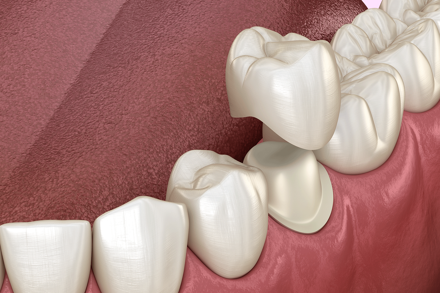 rendering of cown being placed on tooth