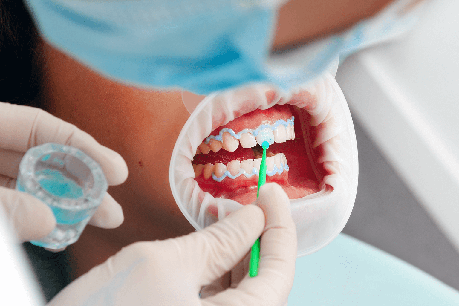 patient wearing dental damn having whitening solution applied to teeth