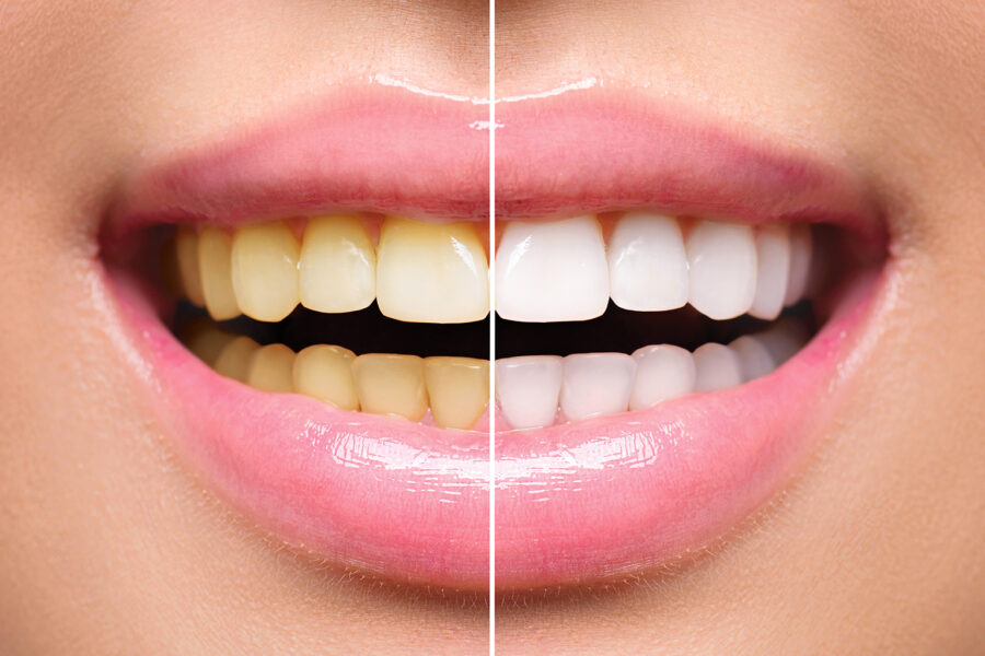 split image of a smile before and after teeth whitening