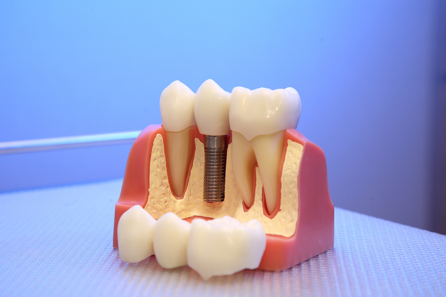 model showing an implant with crown between 2 teeth