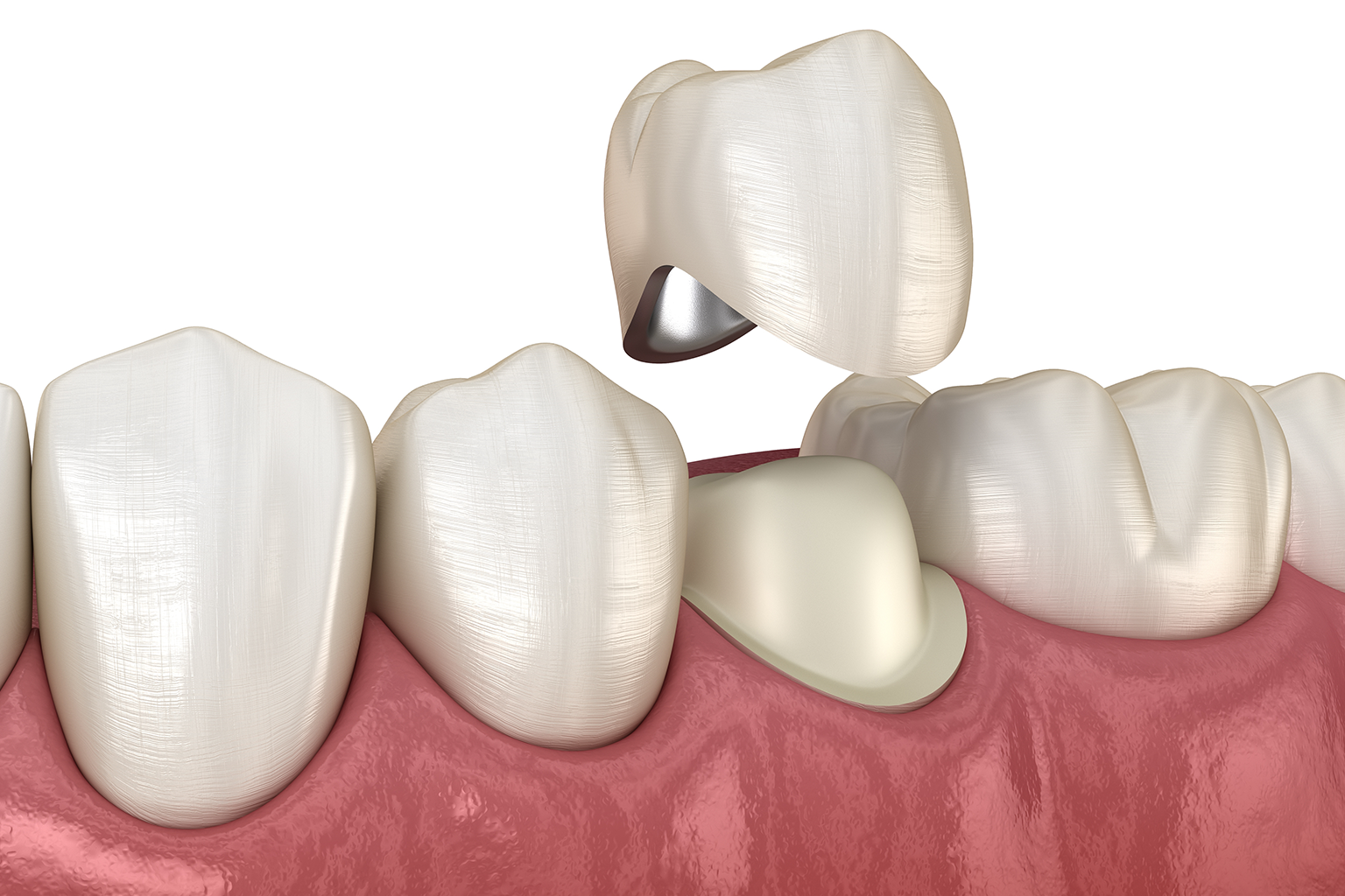 rendering of a crown being placed on a tooth