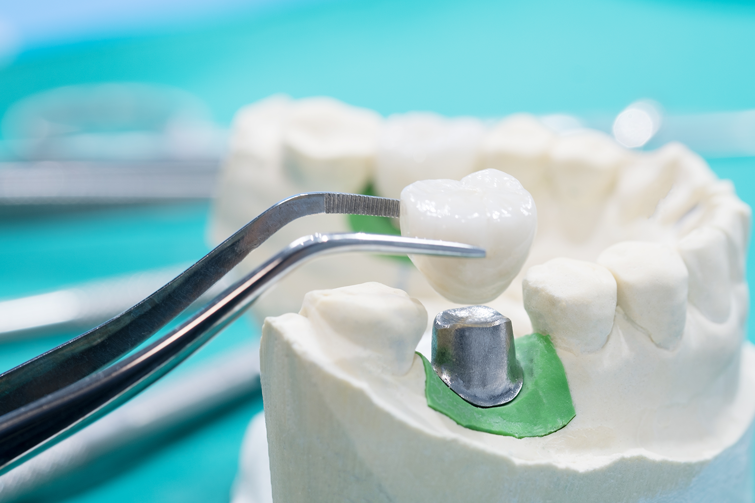 tweezers placing dental crown on abutment in jaw model