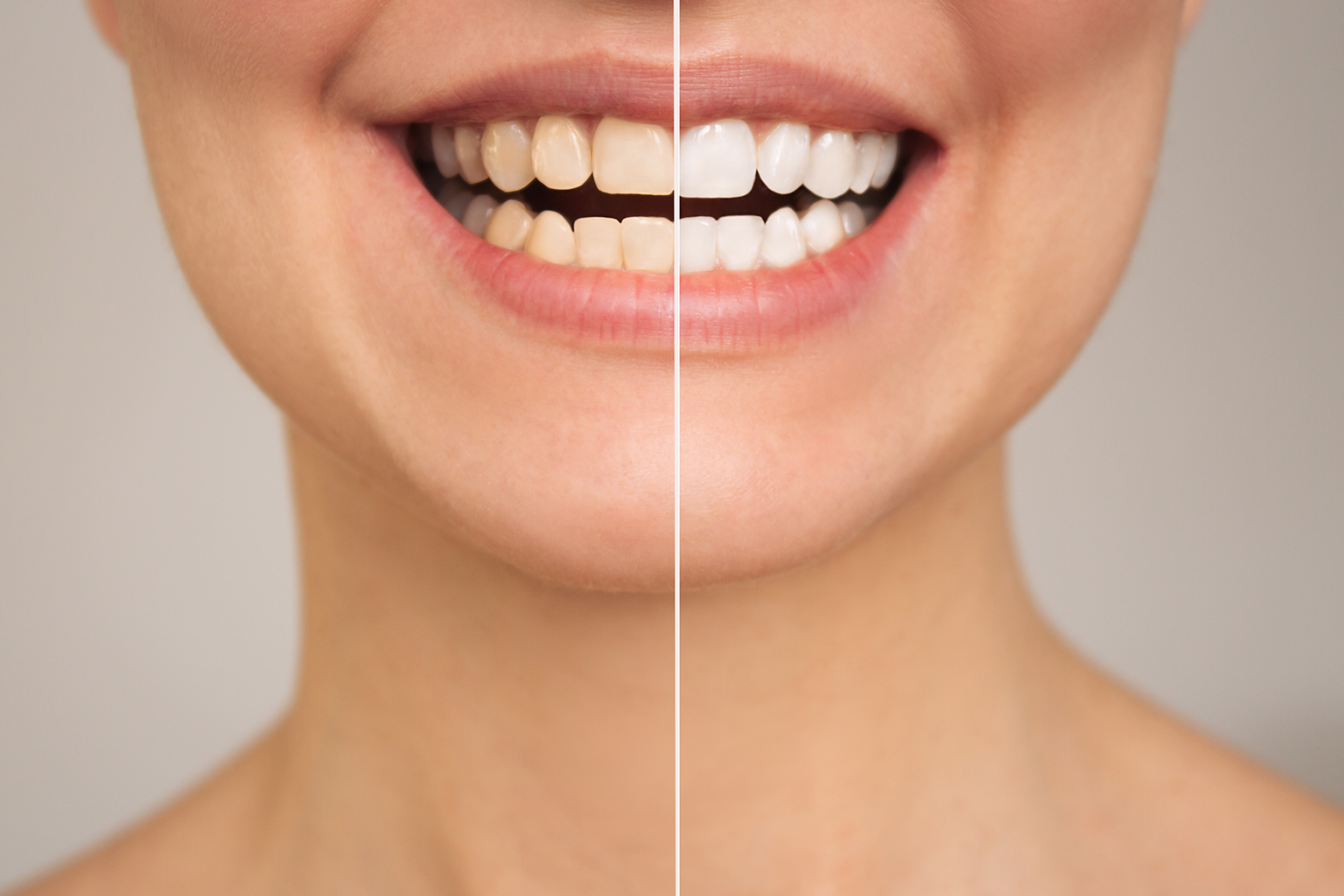 before and after teeth whitening comparison