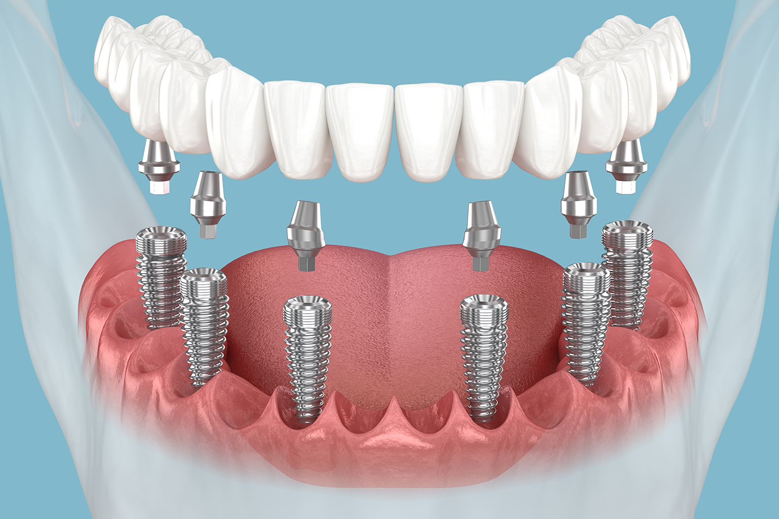 rendering of all-on-6 dental implants with full arch of teeth