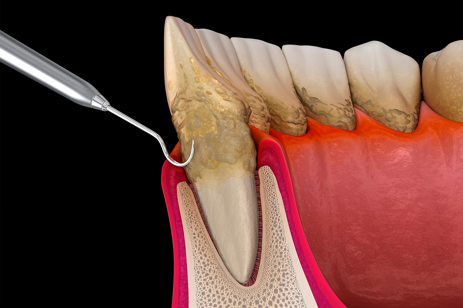 rendering of a dental tool scraping buildup off a tooth