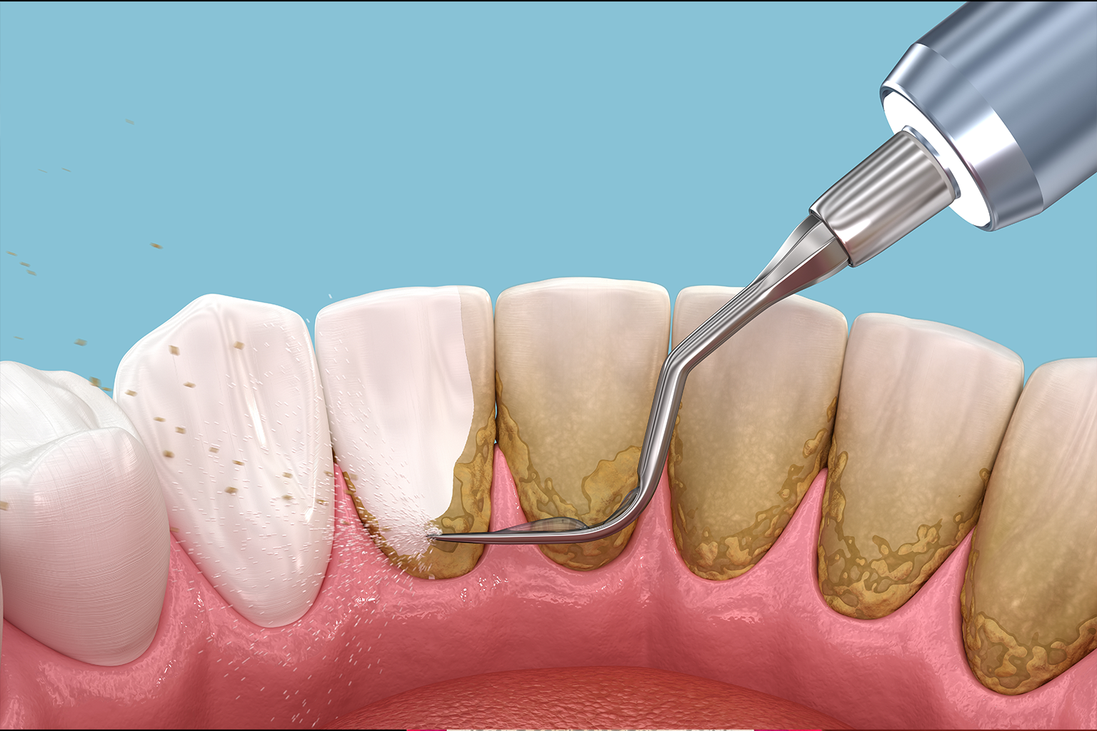 rendering of a dental tool scraping buildup off the back of teeth