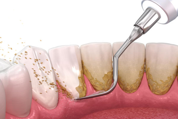 rendering of a dental tool using water to remove buildup off the back of teeth