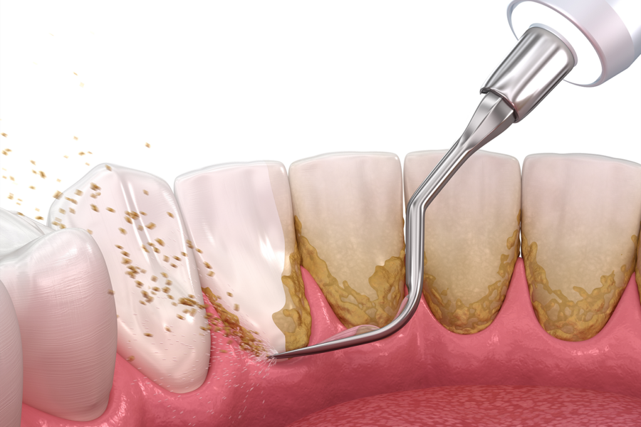 rendering of a dental tool using water to remove buildup off the back of teeth