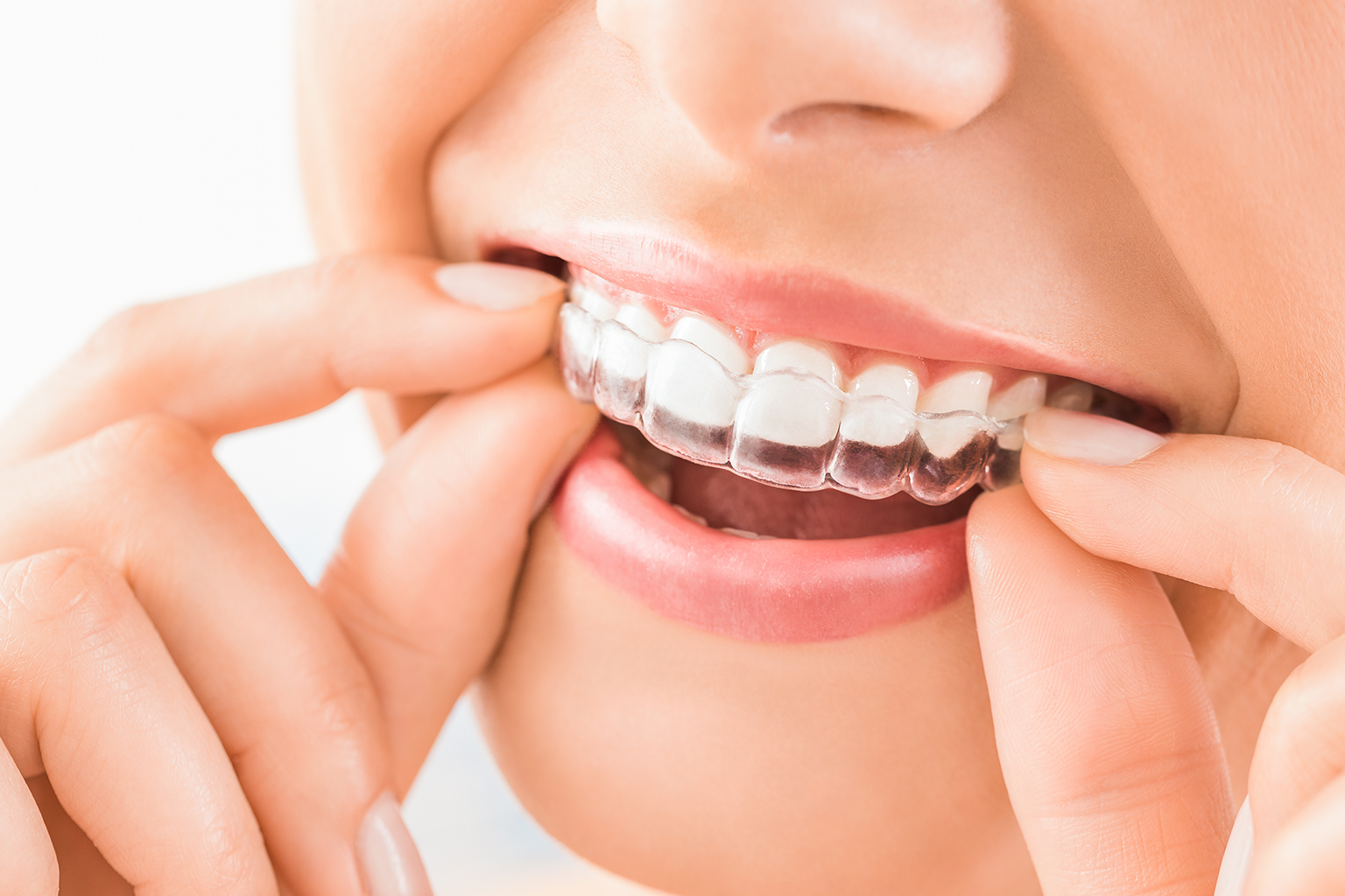 woman placing clear aligner in her mouth