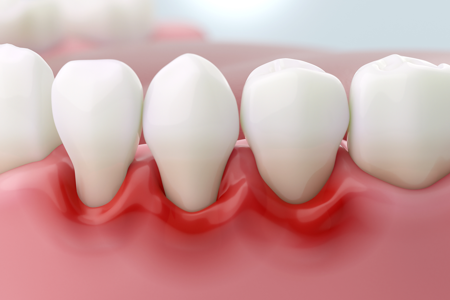 rendering of teeth with receding gums