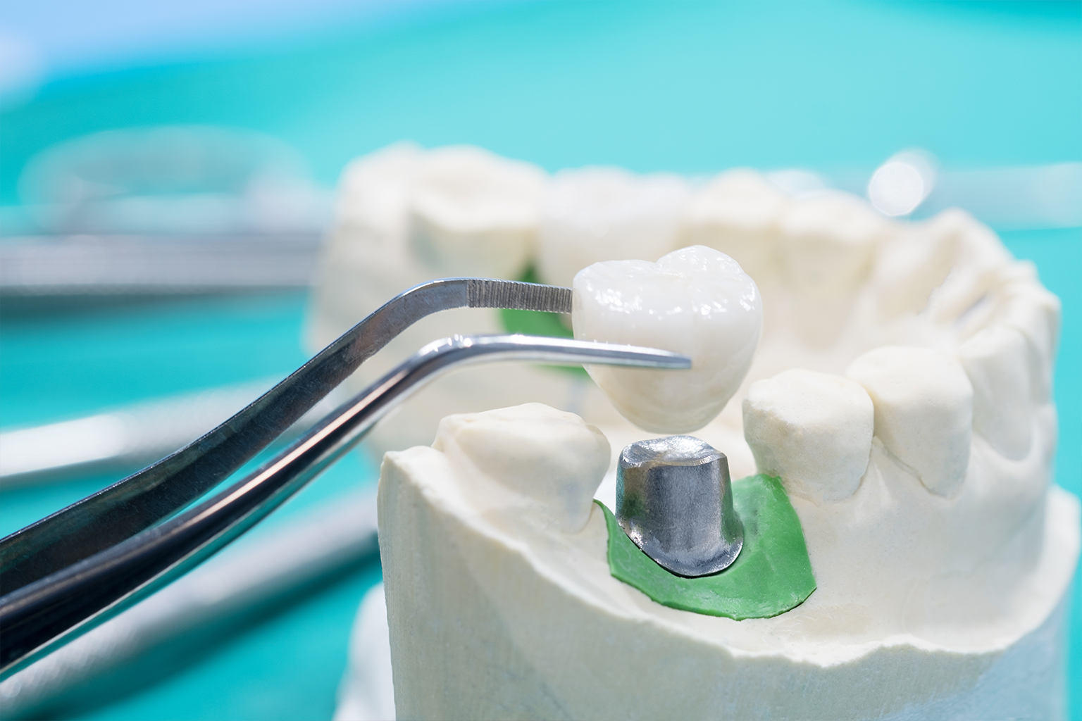 tweezers placing dental crown on jaw model