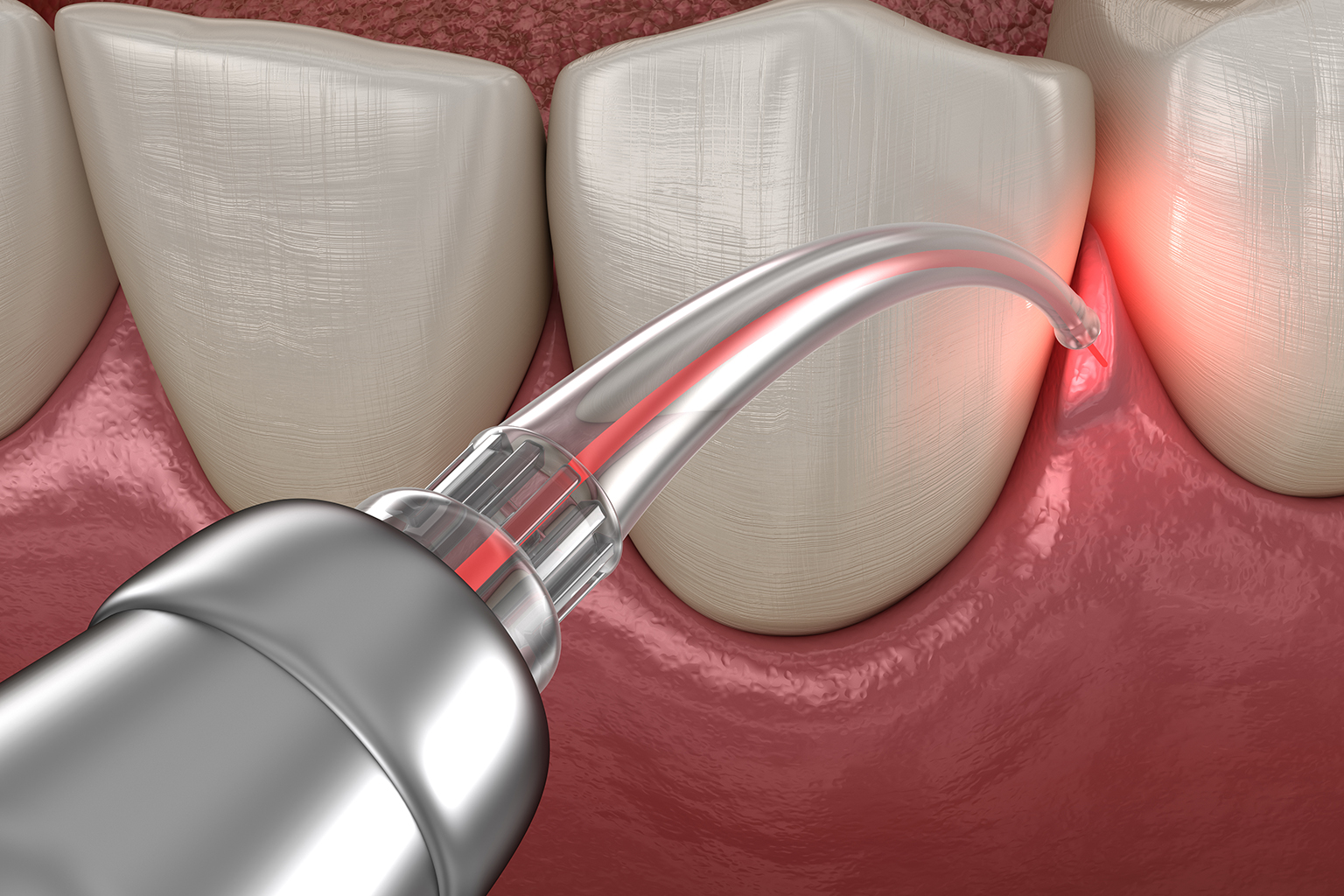 rendering of a dental laser in front of teeth