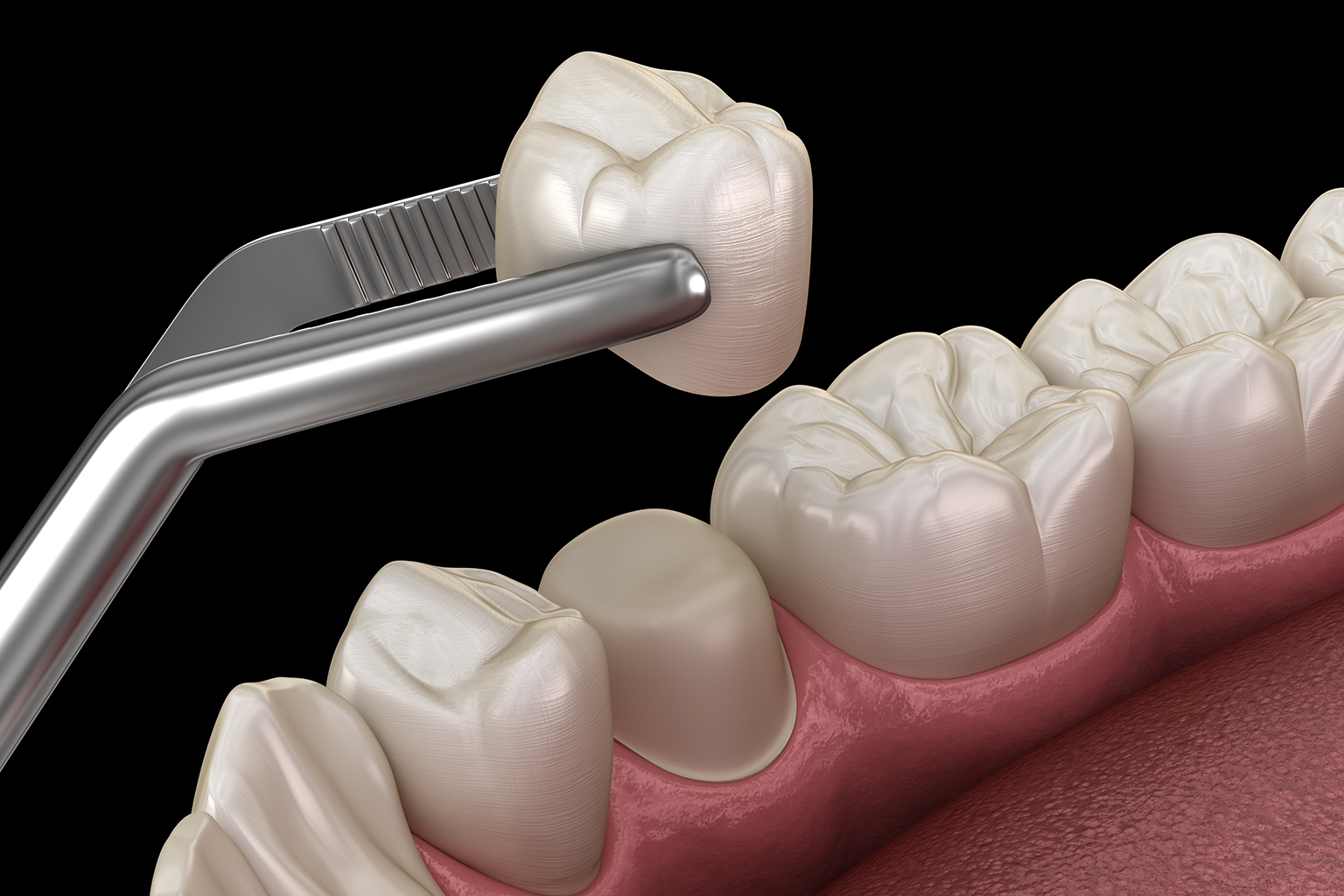 tweezers placing dental crown on filed tooth