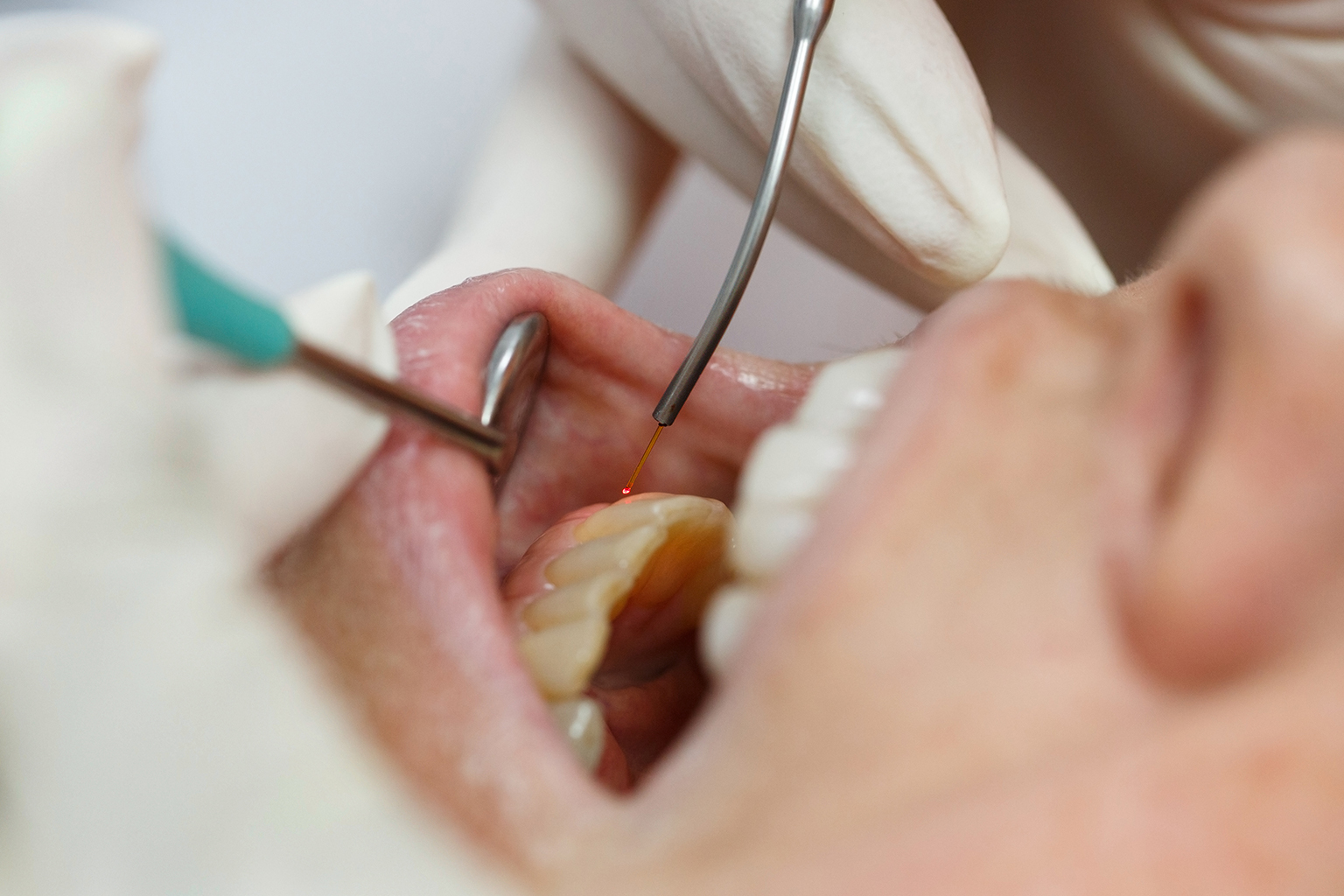 gloved hands using dental laser in patient's mouth