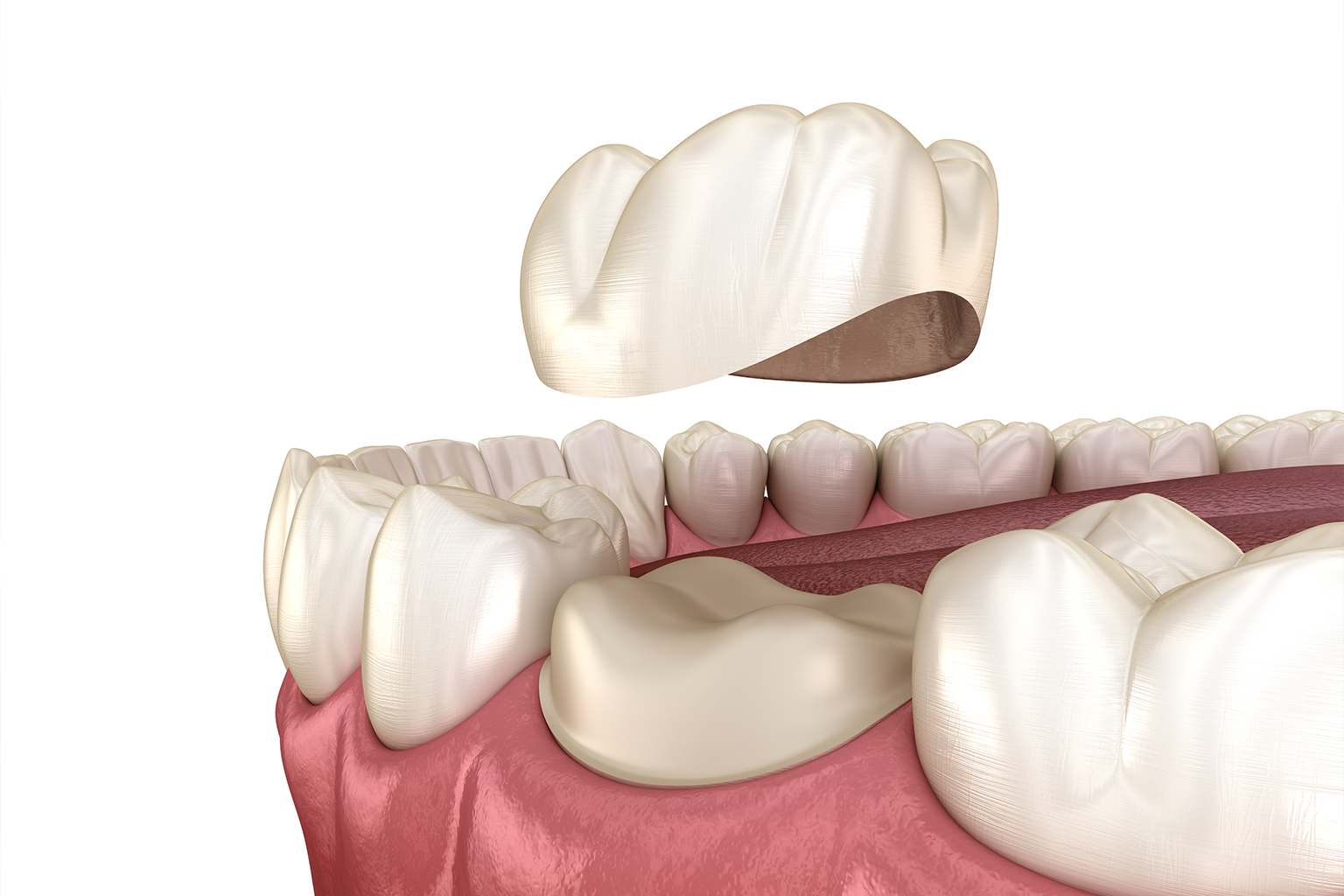 rendering of a dental crown floating above a jaw