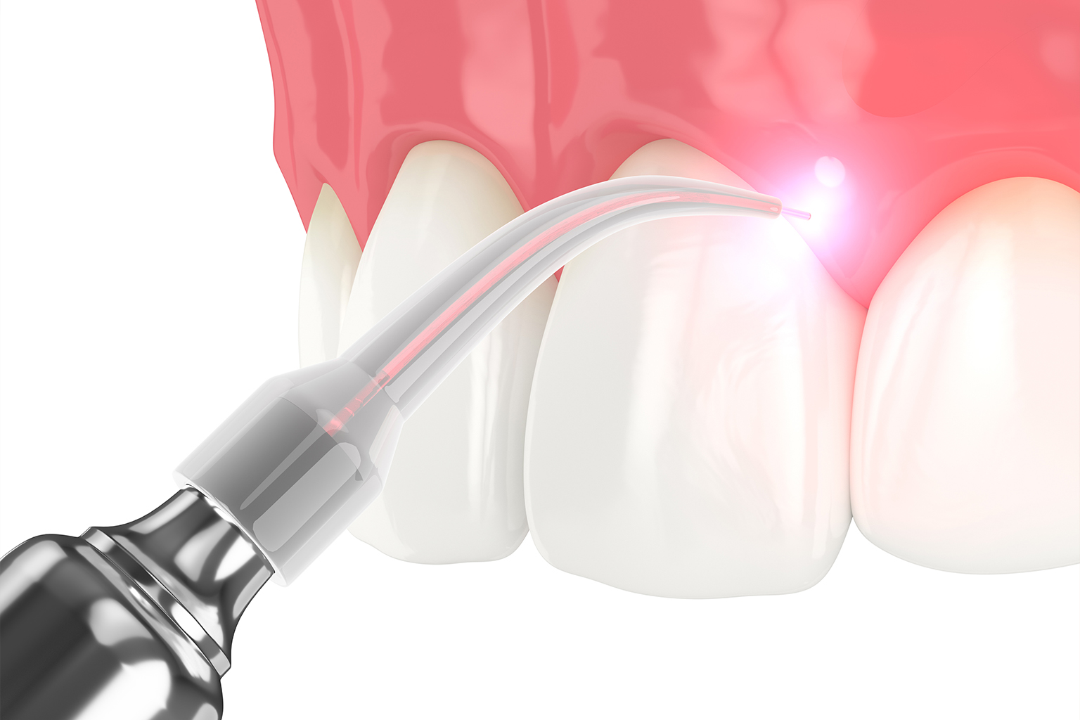 rendering of a dental laser in front of teeth