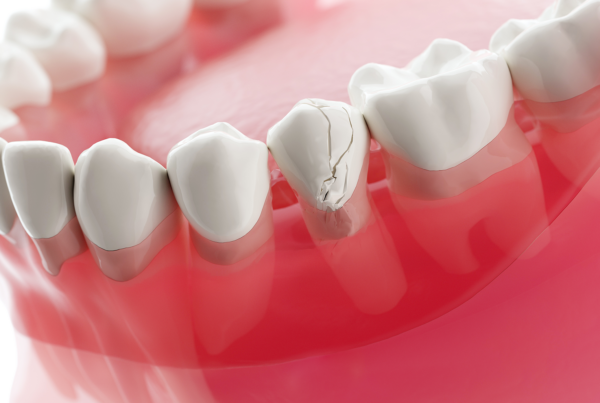 model of a cracked tooth in a lower jaw