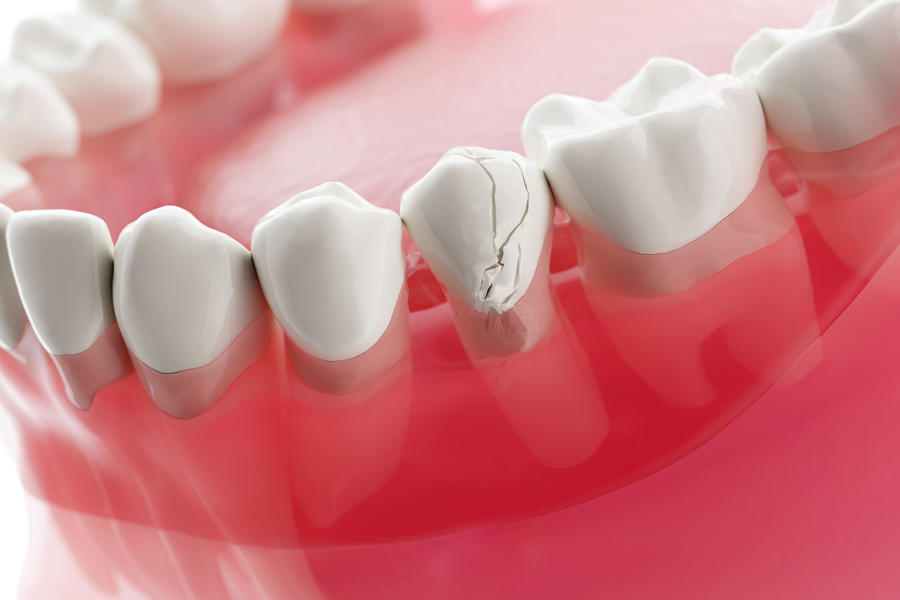 model of a cracked tooth in a lower jaw