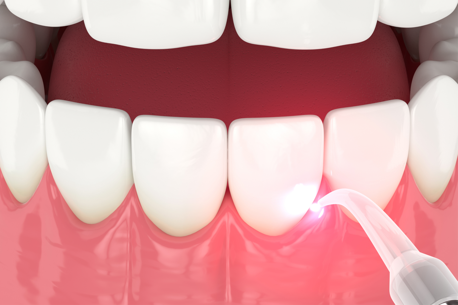 rendering of a dental laser being used on teeth