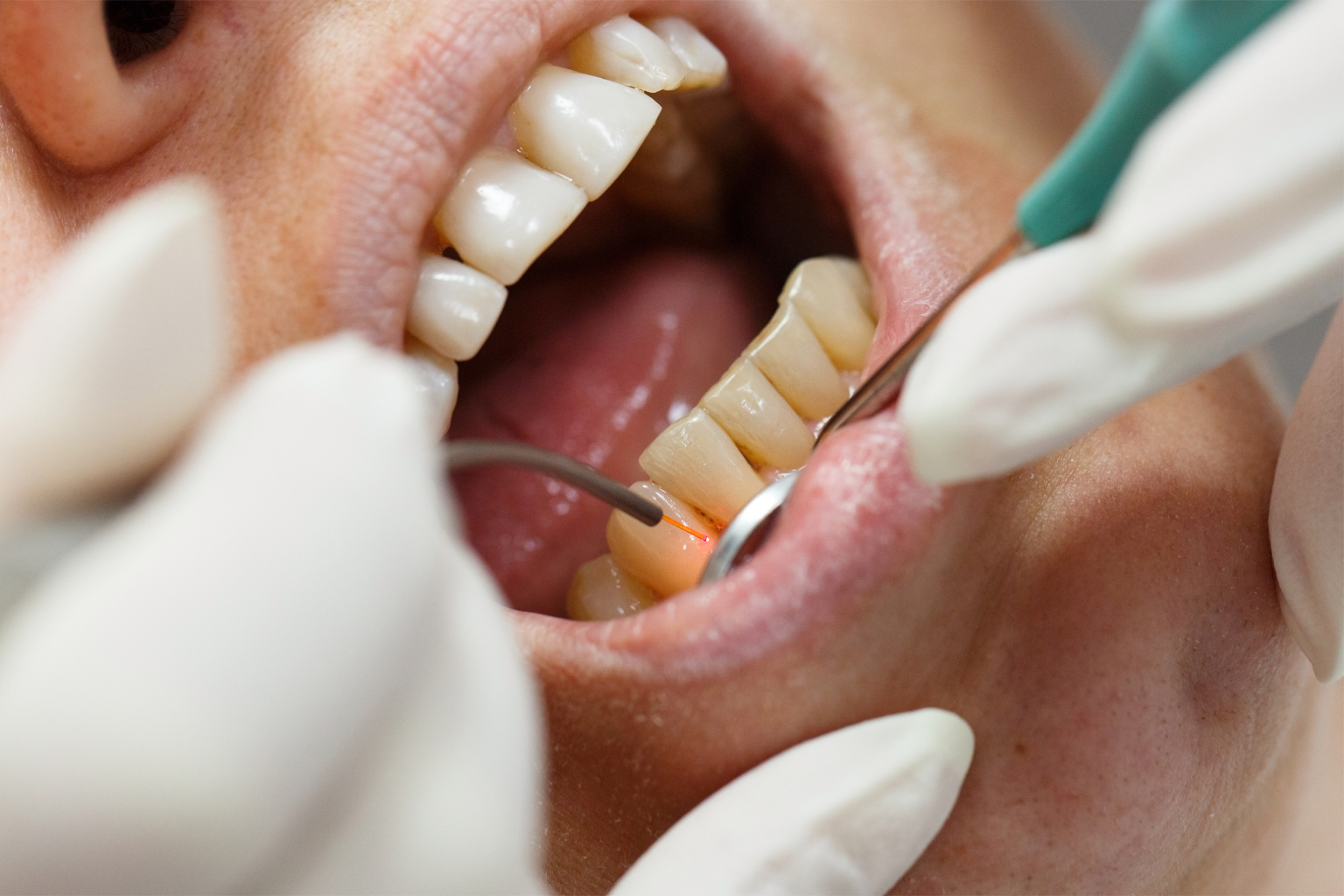 dental laser being used on teeth