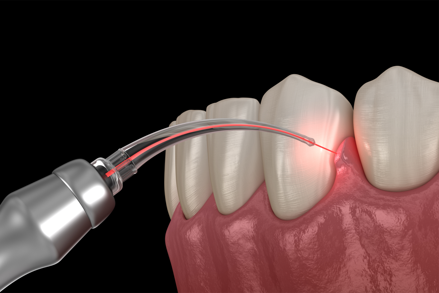 rendering of a dental laser being used on teeth
