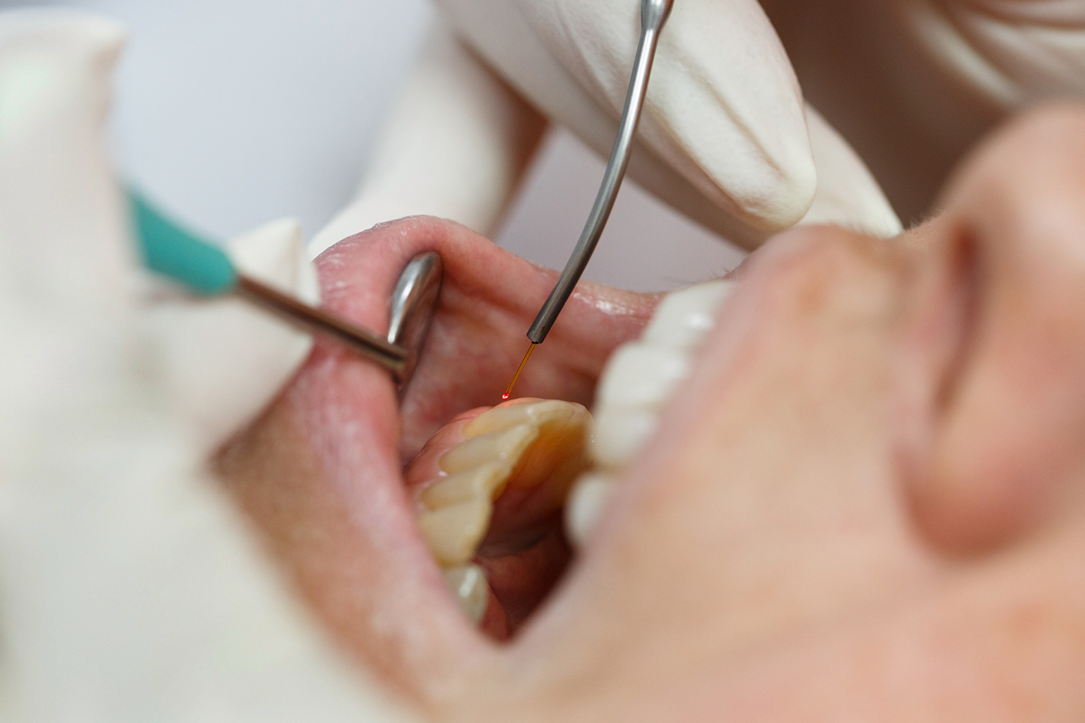 gloved hands using dental laser on lower gums