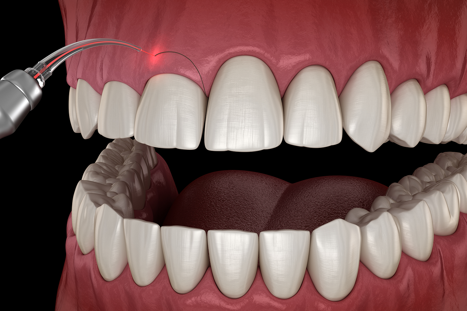 rendering of a dental laser being used on upper gums