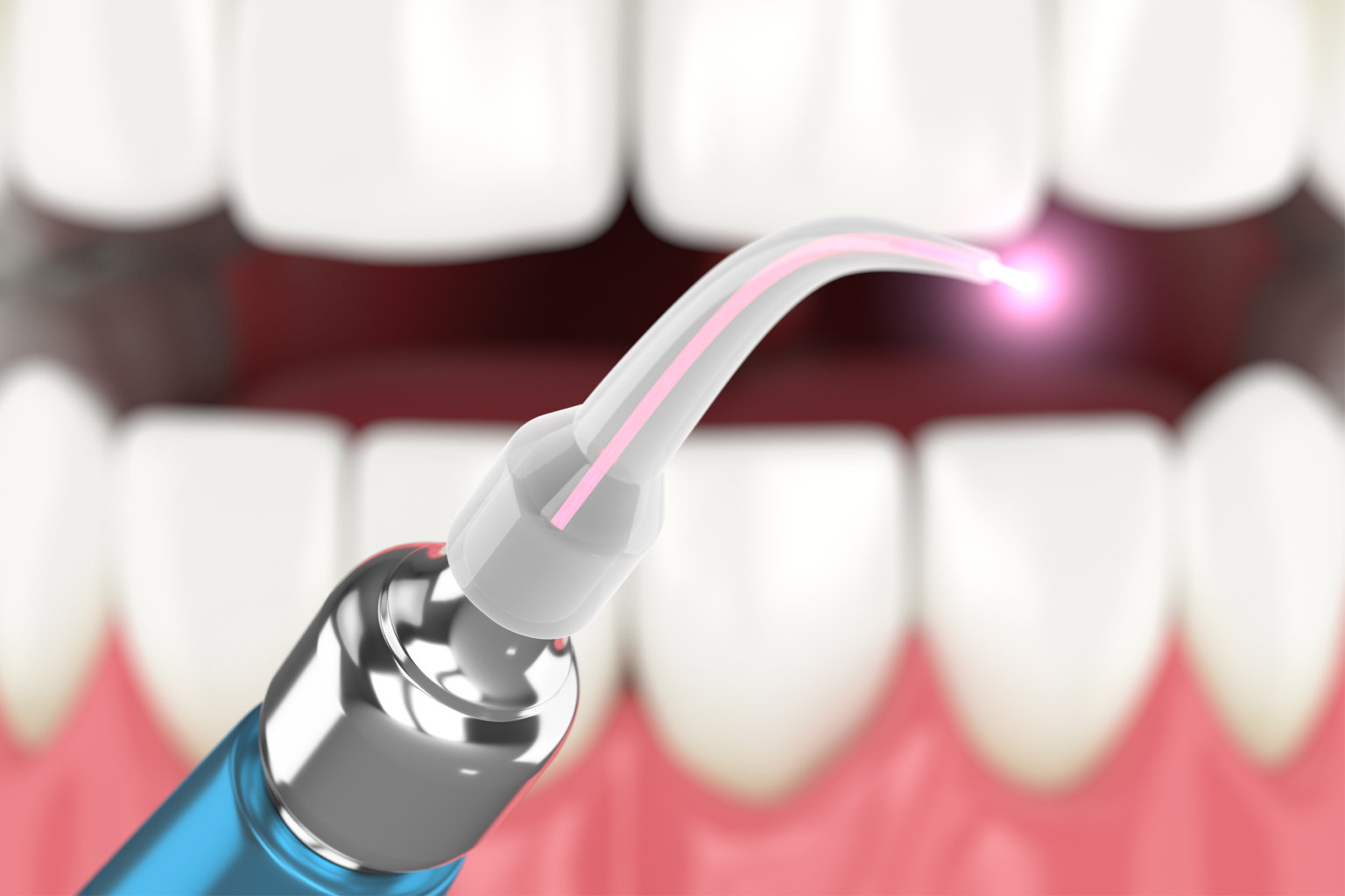rendering of a dental laser being used on teeth