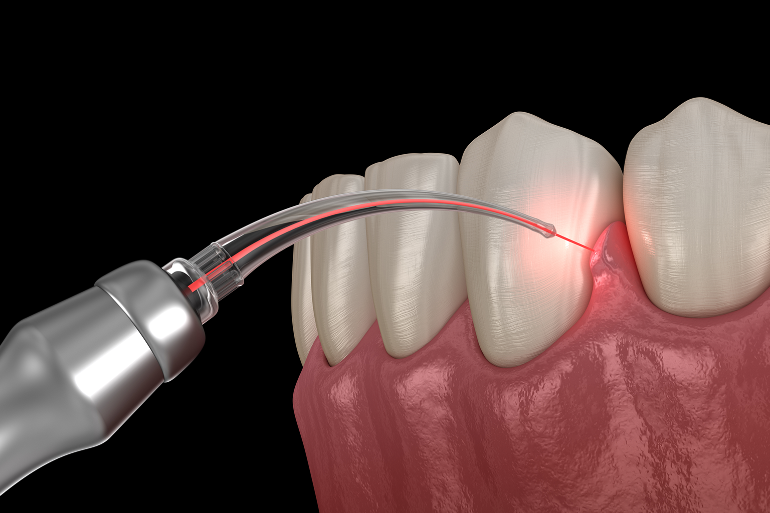 rendering of a dental laser being used on gums