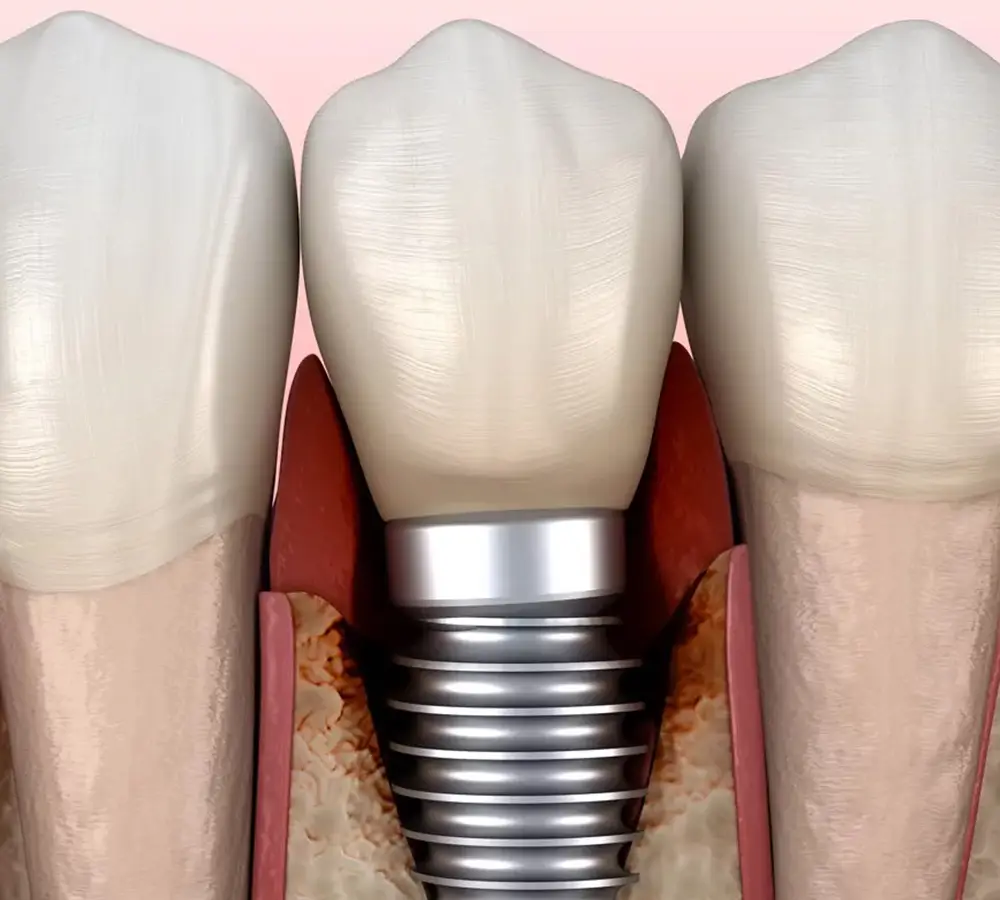 LANAP laser gum therapy before and after"