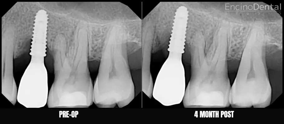 Before and After LAPIP at Encino Dental Studio