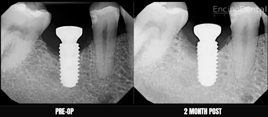 Before and After LAPIP at Encino Dental Studio