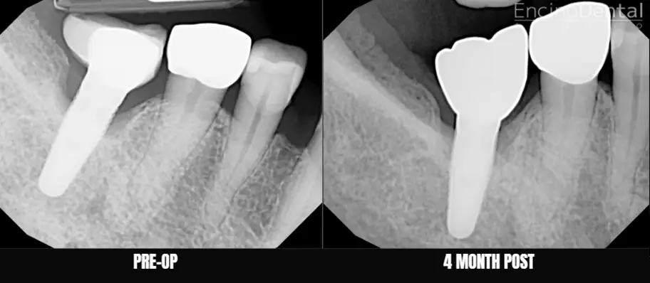Before and After LAPIP at Encino Dental Studio