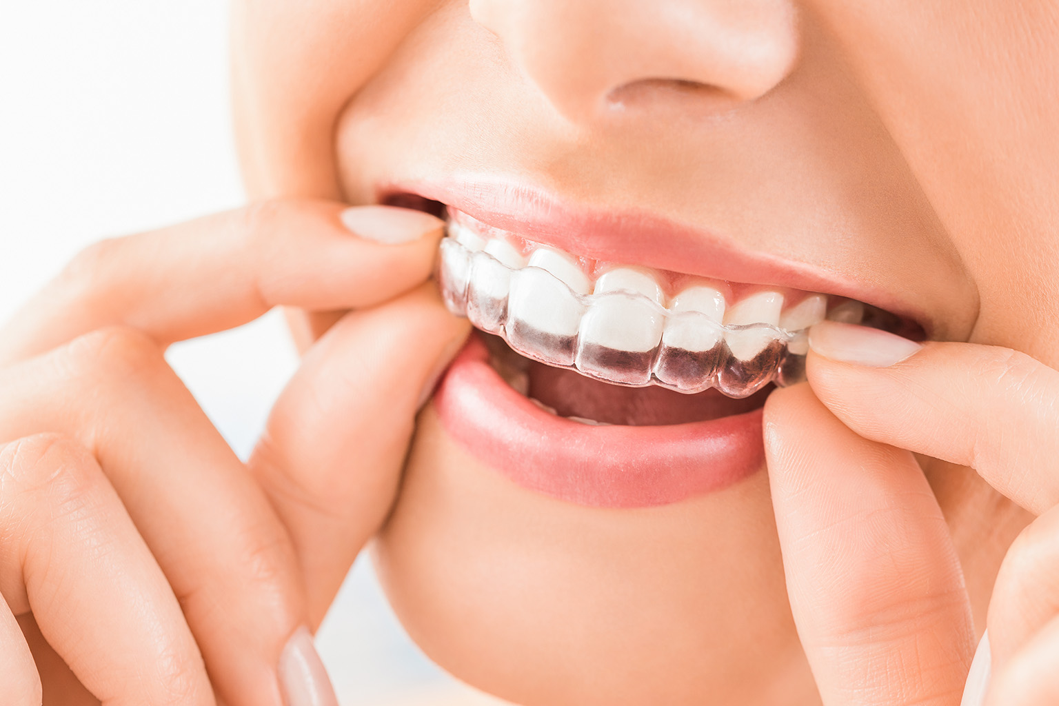 woman placing clear aligner in mouth
