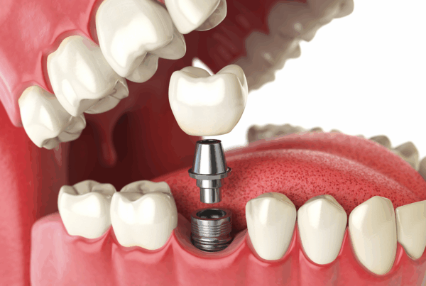 rendering of an implant with receding gums