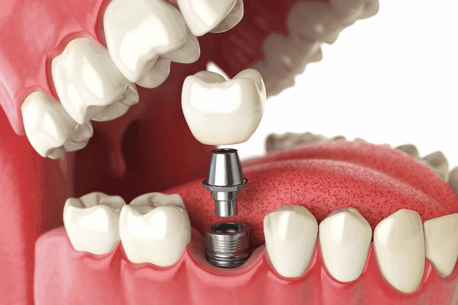 rendering of an implant with receding gums