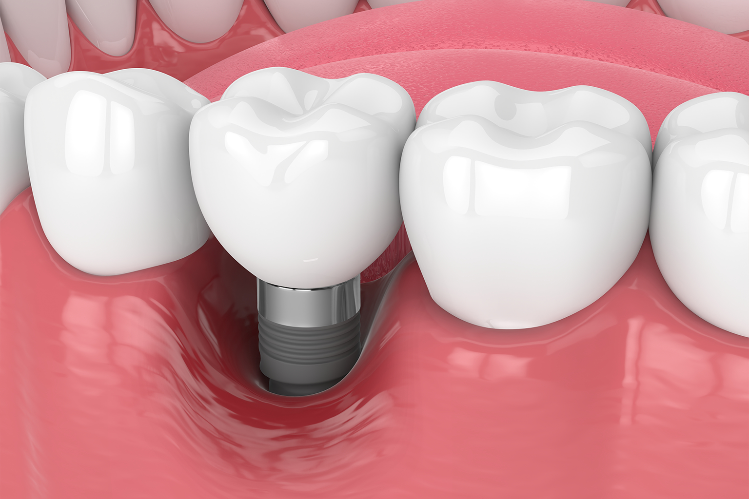 rendering of gums receding from an implant