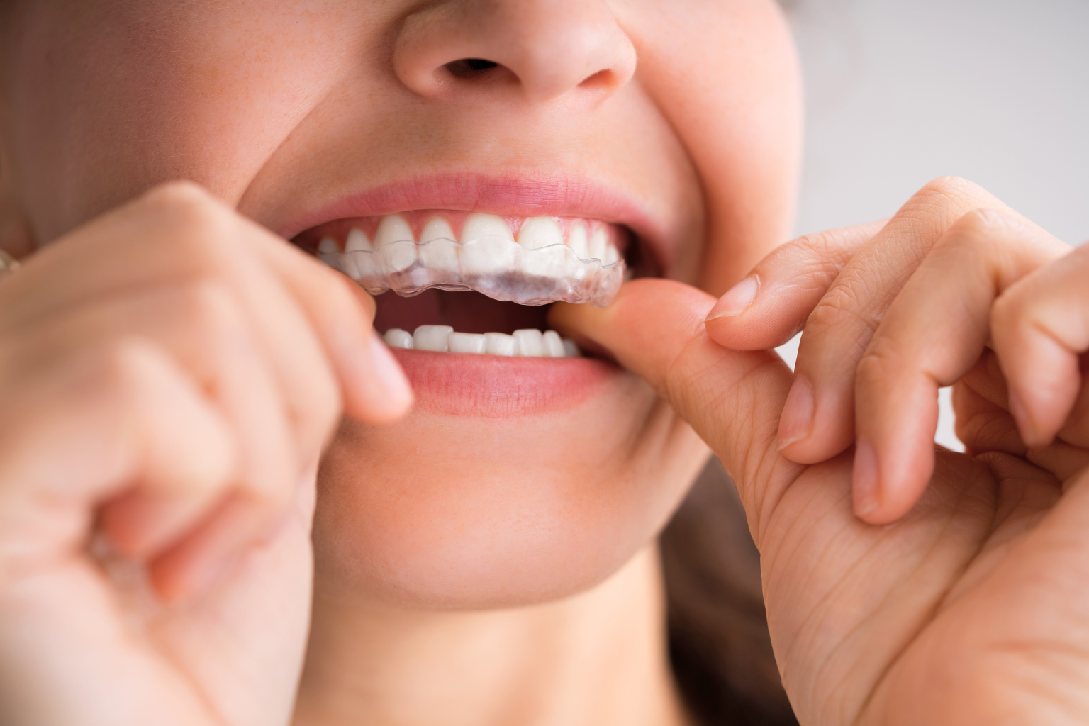 Woman placing clear aligner on upper teeth.