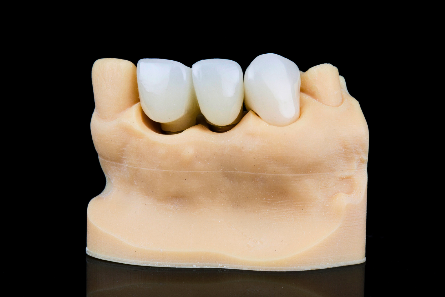 crowns being placed on model teeth