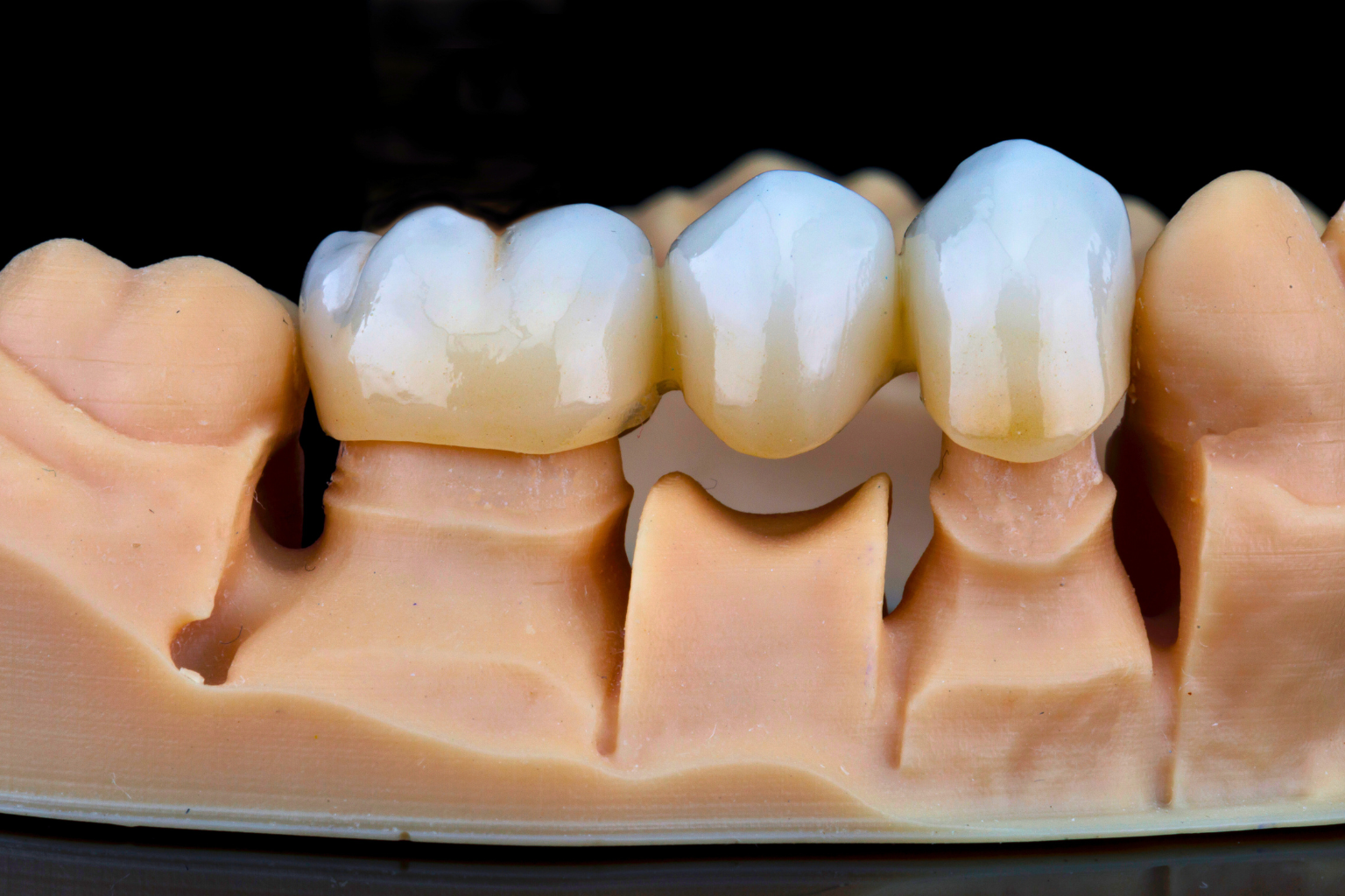 crowns being placed on tooth models