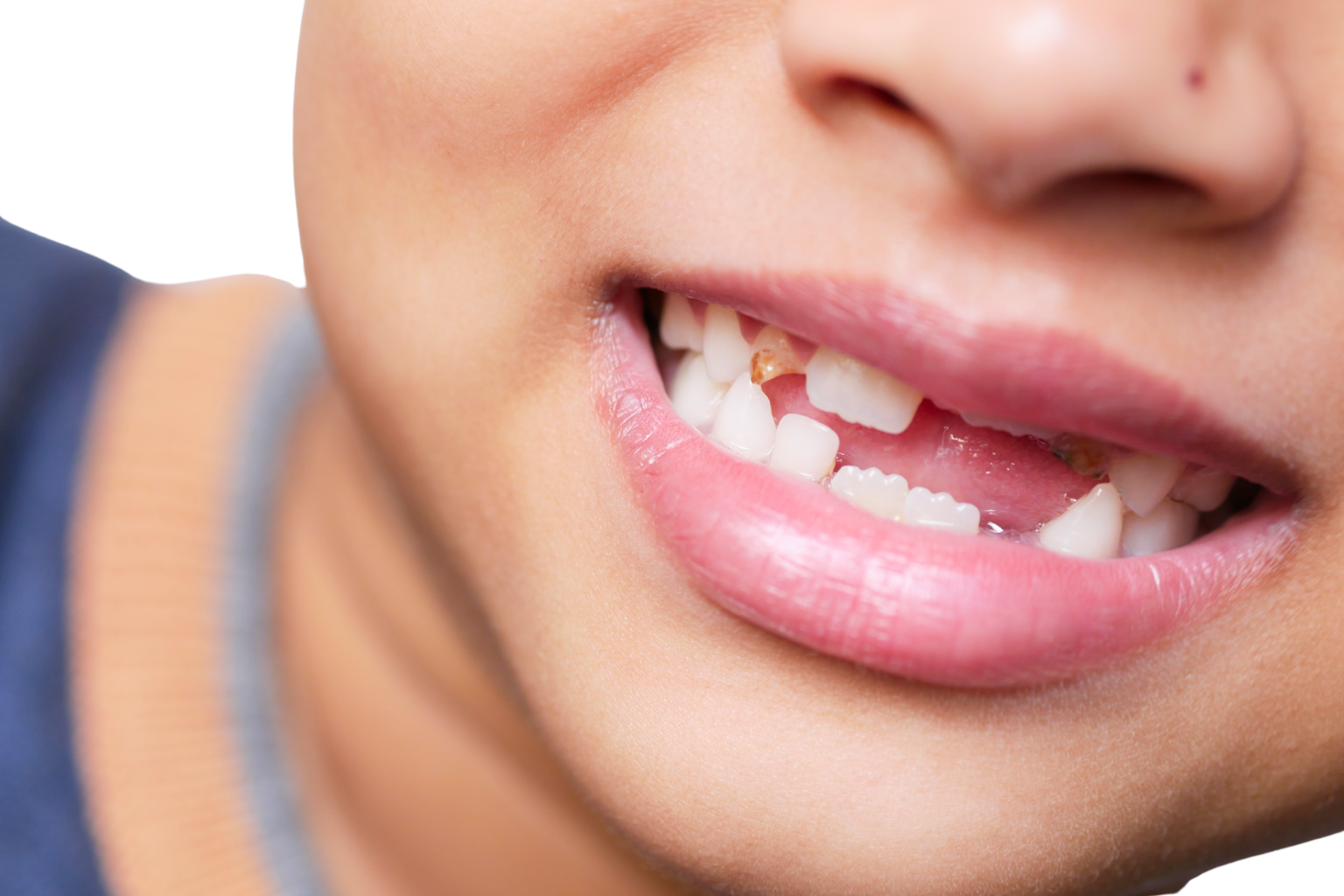 Child's smile showing spaces from missing teeth.
